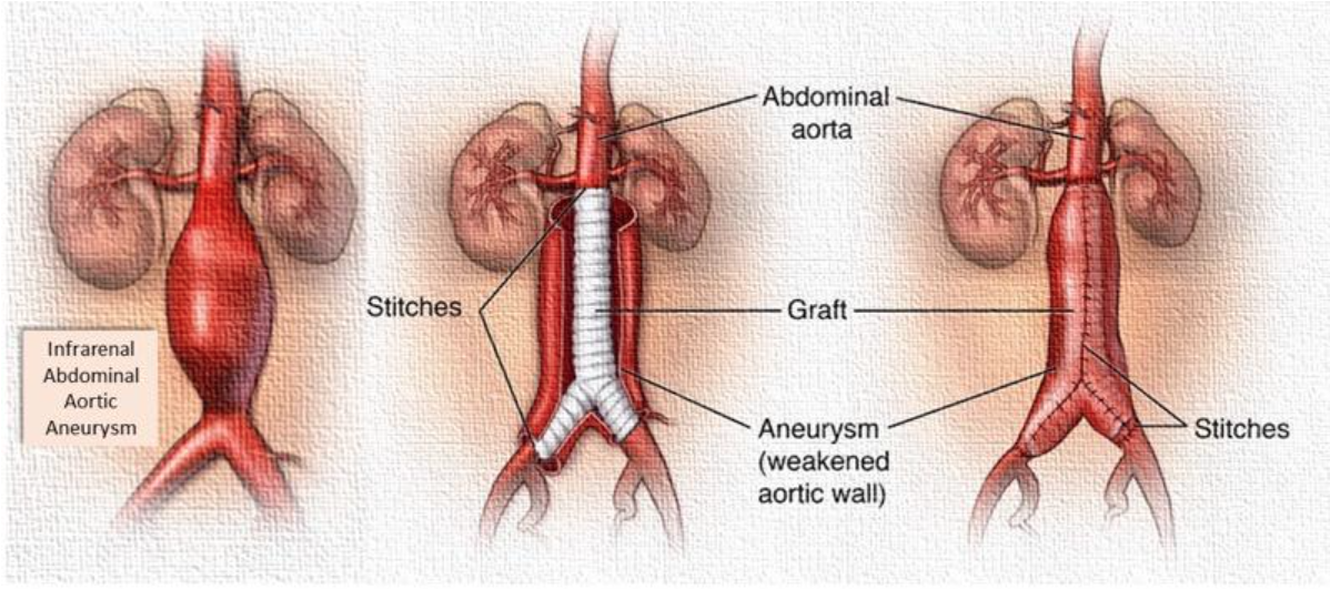 آنوریسم آئورت درمان جراحی باز