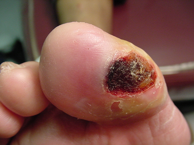 diabetic foot ulcer