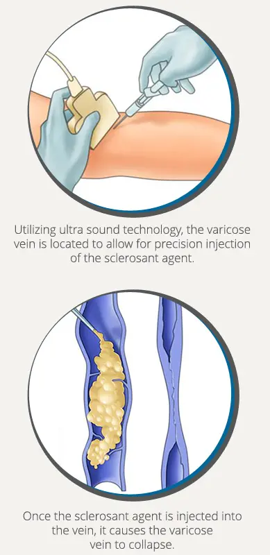 foam sclerotherapy